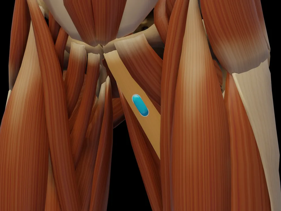 Electrode position on the 3D model: M. Adductor Longus (muscle highlighted, sensor in place)