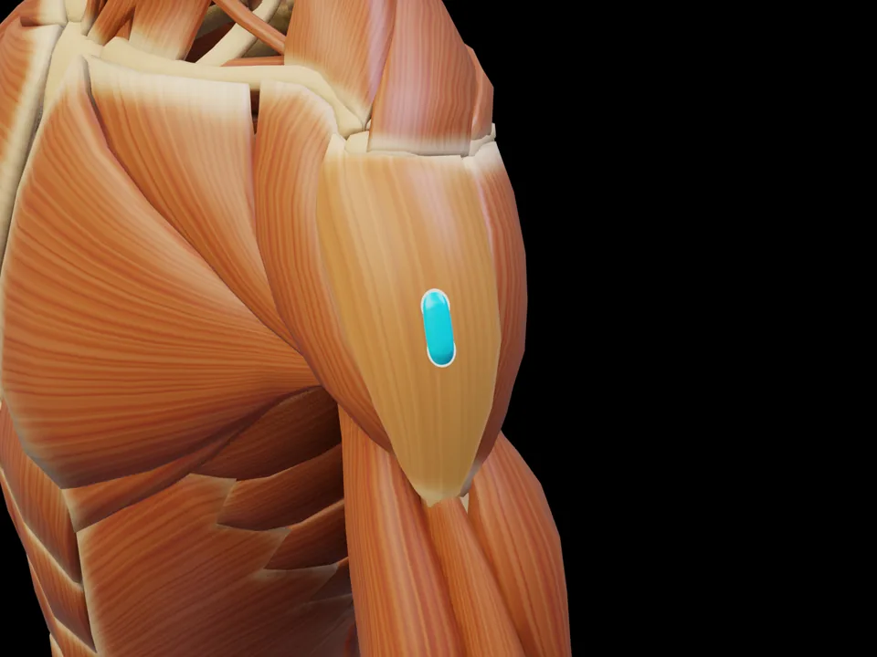 Elektrodenposition am 3D-Modell: M. Deltoideus Pars Acromialis (Muskel hervorgehoben, Sensor platziert)