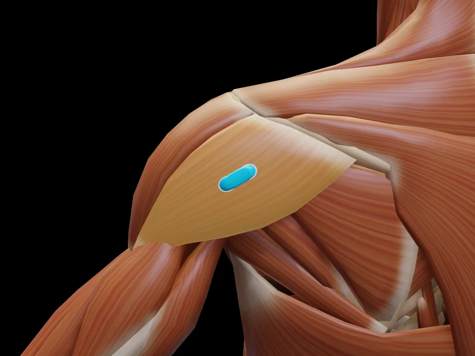 Elektrodenposition am 3D-Modell: M. Deltoideus Pars Spinalis (Muskel hervorgehoben, Sensor platziert)