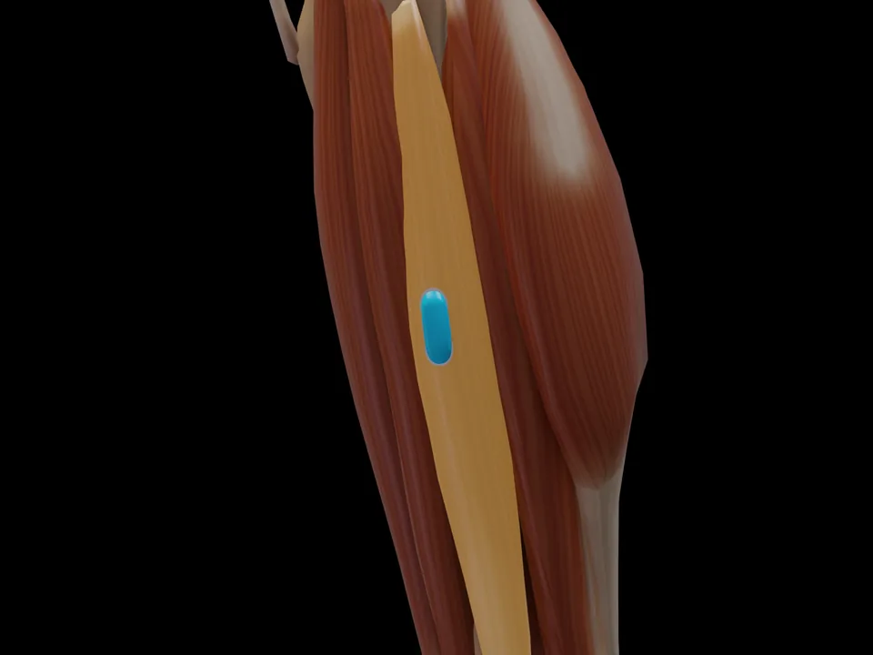 Electrode position on the 3D model: M. Fibularis Longus (muscle highlighted, sensor in place)
