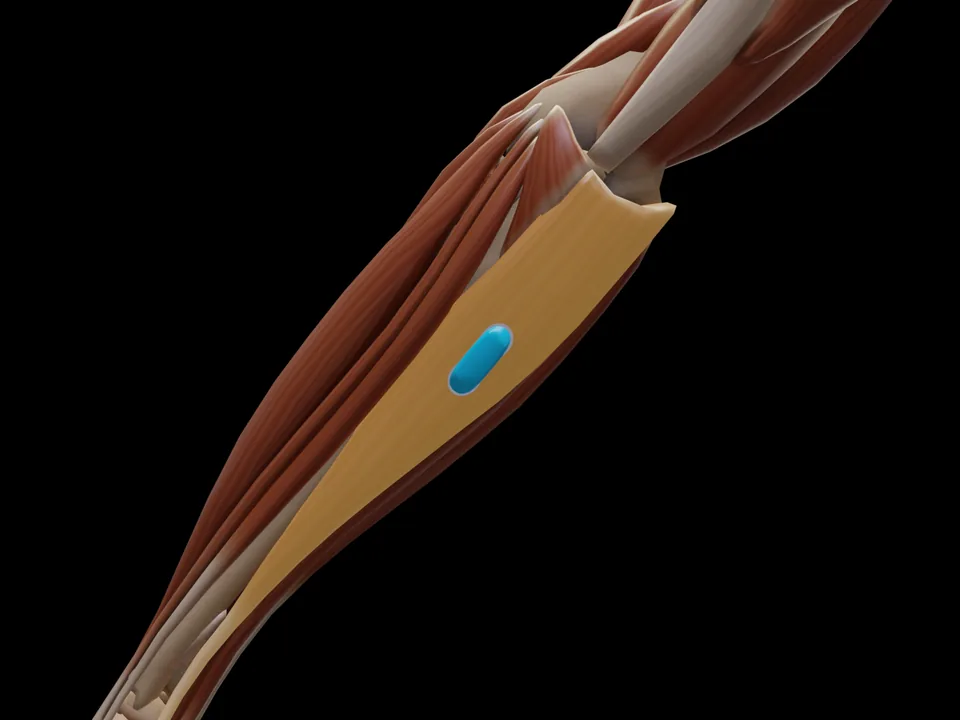 Elektrodenposition am 3D-Modell: M. Flexor Carpi Ulnaris (Muskel hervorgehoben, Sensor platziert)