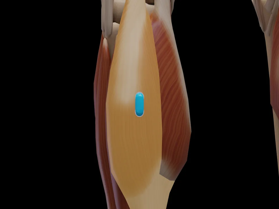 Elektrodenposition am 3D-Modell: M. Gastrocnemius Caput Laterale (Muskel hervorgehoben, Sensor platziert)