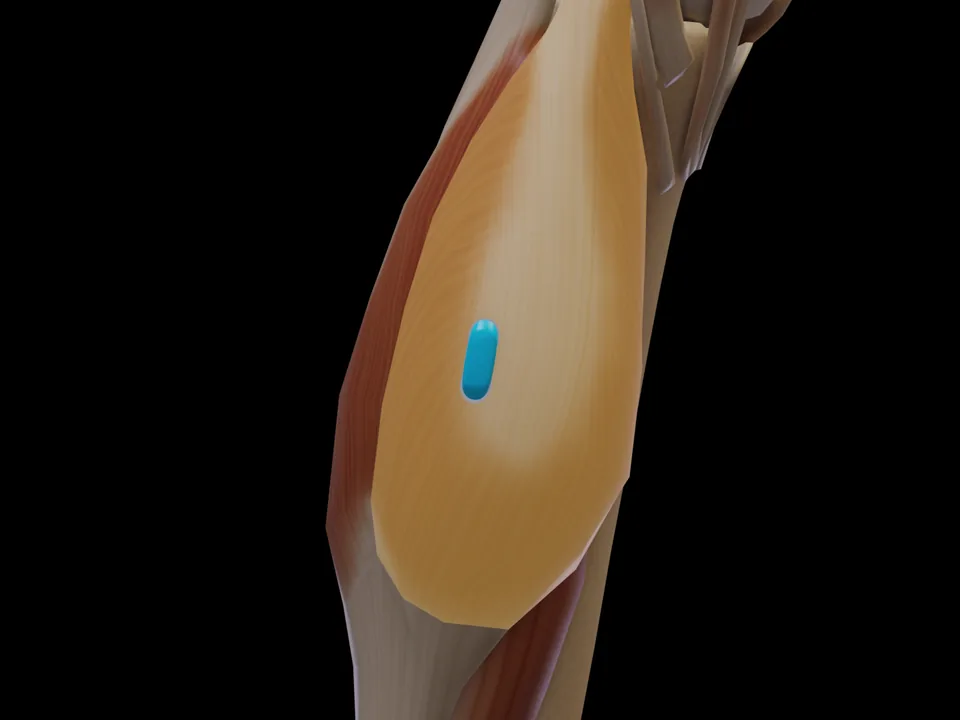 Electrode position on the 3D model: M. Gastrocnemius Caput Mediale (muscle highlighted, sensor in place)