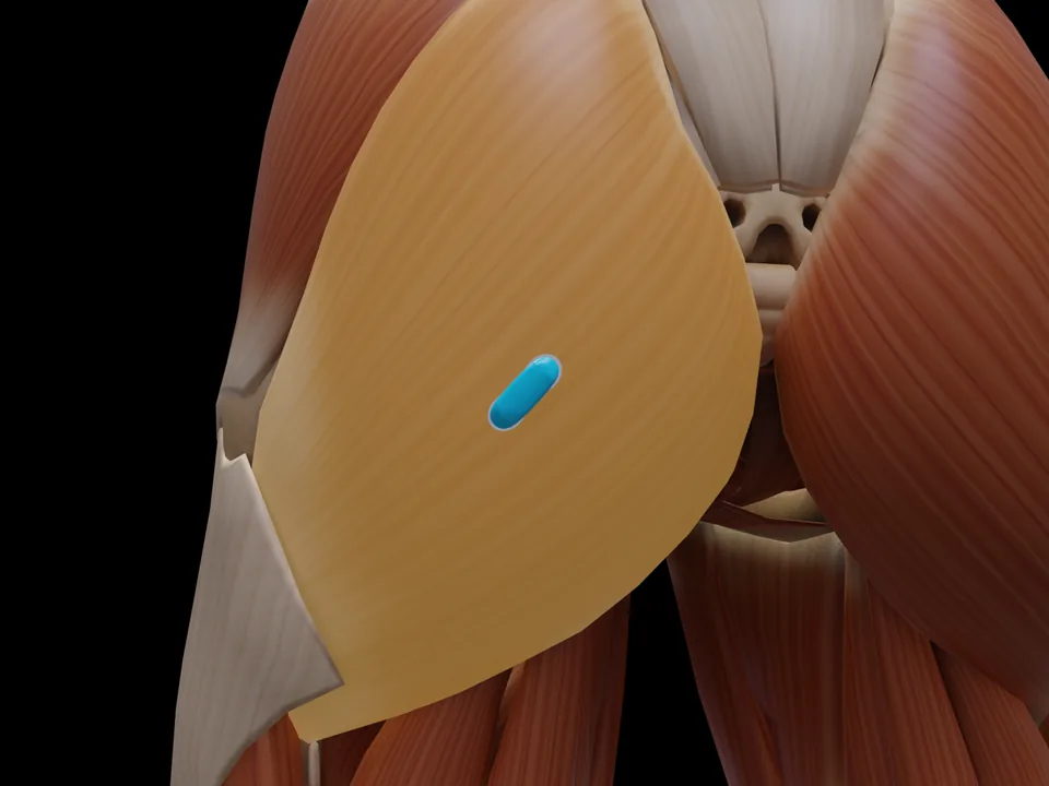 Electrode position on the 3D model: M. Gluteus Maximus (muscle highlighted, sensor in place)