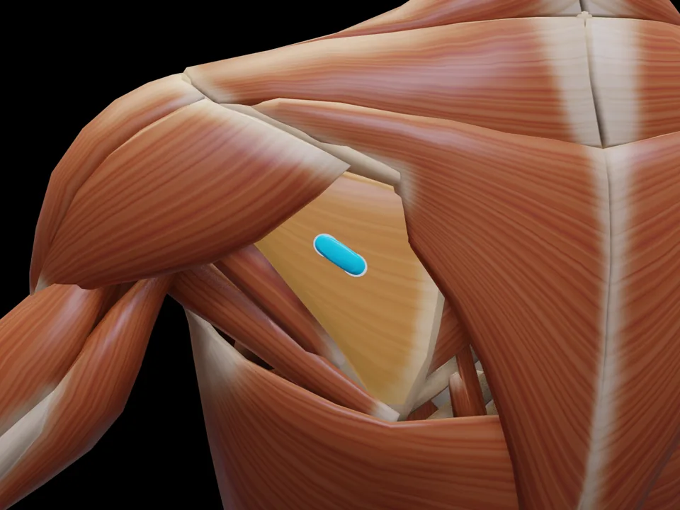 Electrode position on the 3D model: M. Infraspinatus (muscle highlighted, sensor in place)