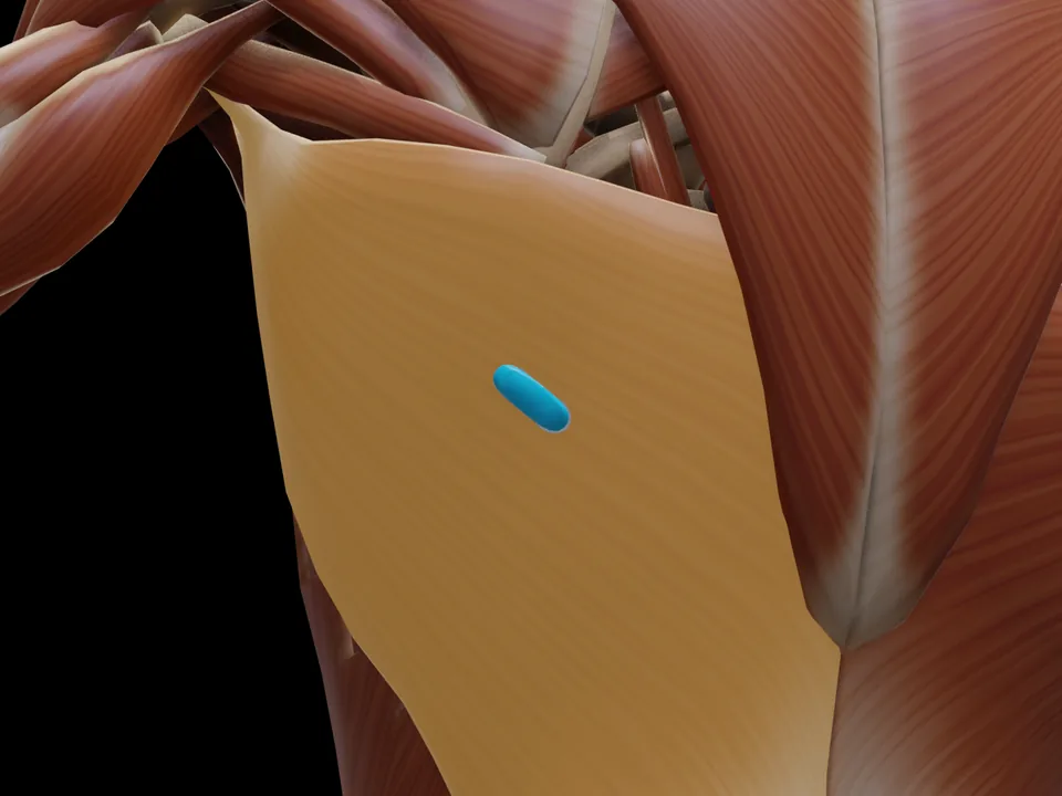 Electrode position on the 3D model: M. Latissimus Dorsi (muscle highlighted, sensor in place)