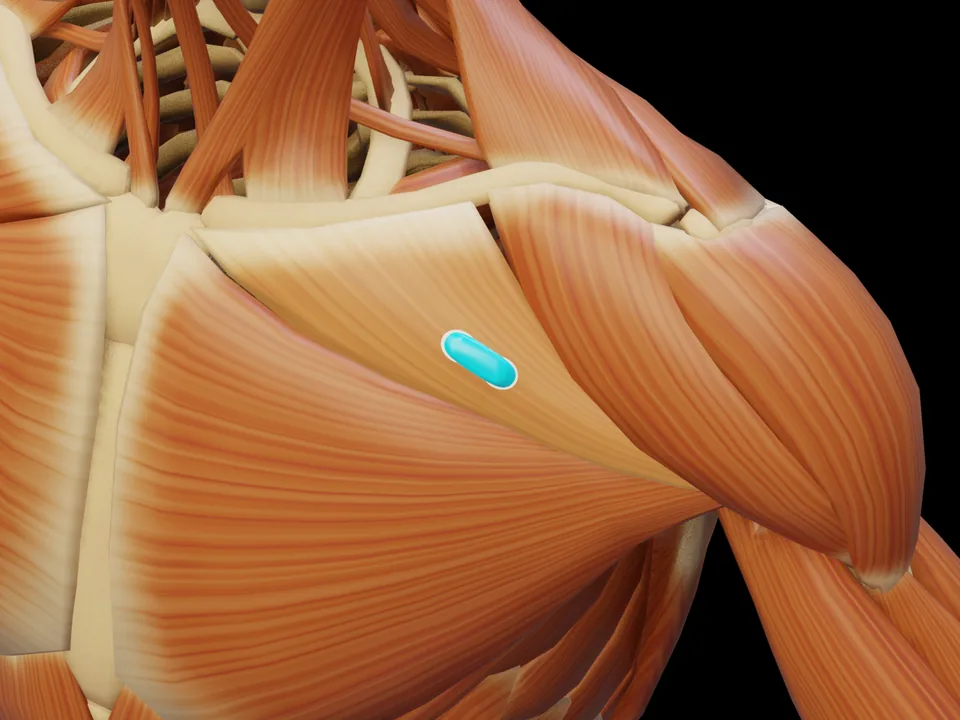 Electrode position on the 3D model: M. Pectoralis Major Pars Clavicularis (muscle highlighted, sensor in place)