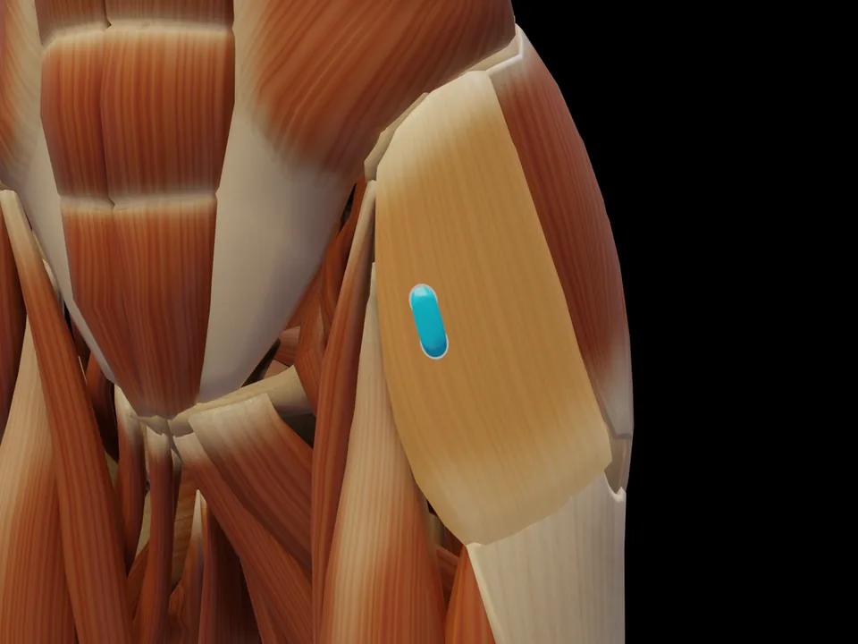 Elektrodenposition am 3D-Modell: M. Tensor Fasciae Latae (Muskel hervorgehoben, Sensor platziert)
