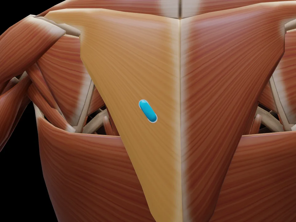 Elektrodenposition am 3D-Modell: M. Trapezius Pars Ascendens (Muskel hervorgehoben, Sensor platziert)