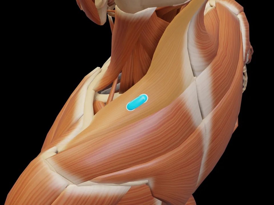 Electrode position on the 3D model: M. Trapezius Pars Descendens (muscle highlighted, sensor in place)